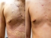 “난치성 피부질환 건선, 줄기세포로 피부 면역 개선”